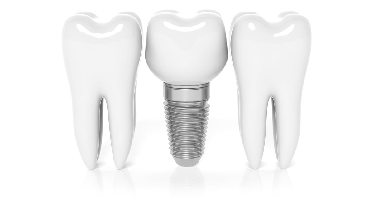 dental implant