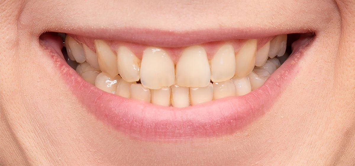 close up of yellow teeth